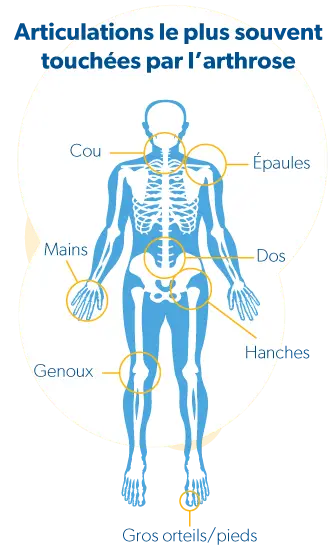 Les zones du corps les plus souvent touchées par l'arthrose